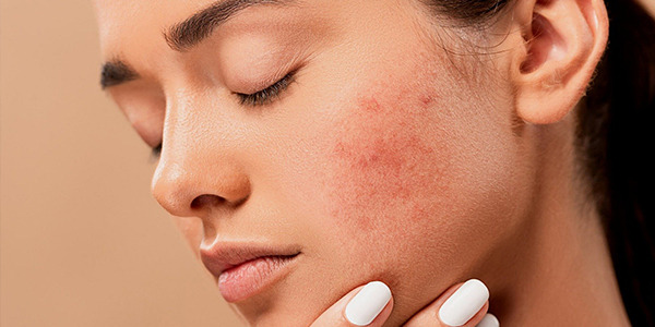 Acné et problèmes de peau: conseils et produits conseillés 